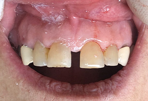 Ideal Dental Care | Night Guards, Oral Cancer Screening and Veneers