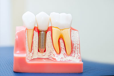 Ideal Dental Care